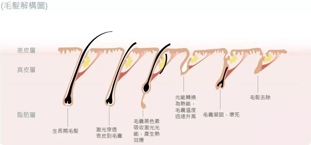 “白煮蛋”與“獼猴桃”之間，還差一個(gè)它 強(qiáng)脈沖脫毛器械，值得買(mǎi)嗎？